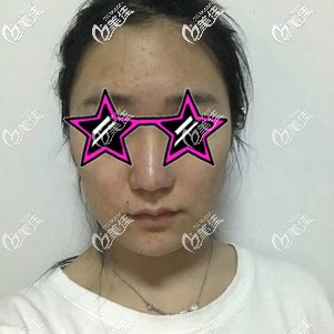 做手術(shù)前自己下垂的面部 做手術(shù)前自己下垂的面部