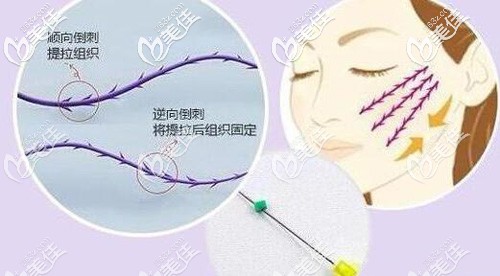 醫(yī)生給出的埋線提升手術(shù)原理 醫(yī)生給出的埋線提升手術(shù)原理