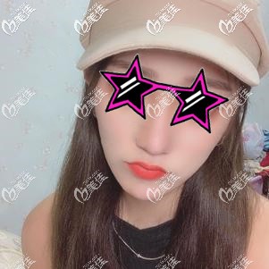 做了面部埋線提升手術(shù)后臉疼是正?，F(xiàn)象嗎？以我過來人的身份給你們說說