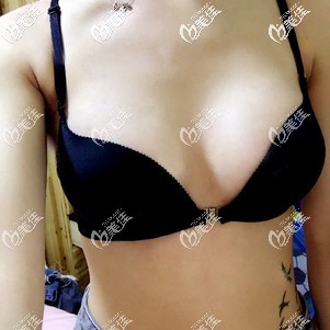 杭州連天美假體隆胸案例