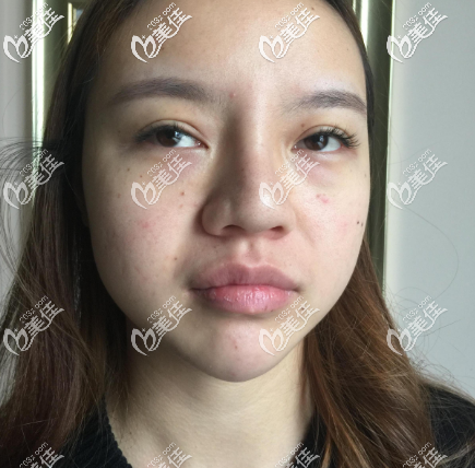 在廣州美萊做面部吸脂術(shù)前照片 在廣州美萊做面部吸脂術(shù)前照片