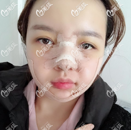 廣州美萊張毓面部吸脂術(shù)后7天效果 廣州美萊張毓面部吸脂術(shù)后7天效果