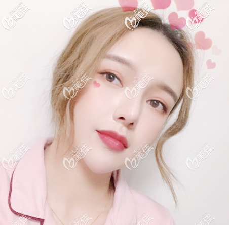 找廣州美萊張毓做的面部吸脂效果特別好,術(shù)后一年沒(méi)有反彈也沒(méi)有下垂拍照更上鏡了