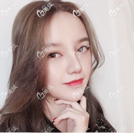 廣州美萊張毓面部吸脂術(shù)后15天效果圖 廣州美萊張毓面部吸脂術(shù)后15天效果圖