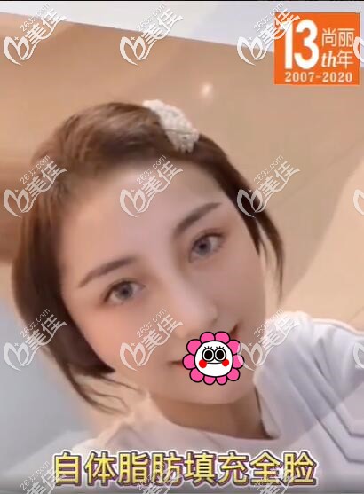 自體脂肪面部填充術后兩個月