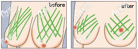 不開刀人工韌帶提胸效果圖