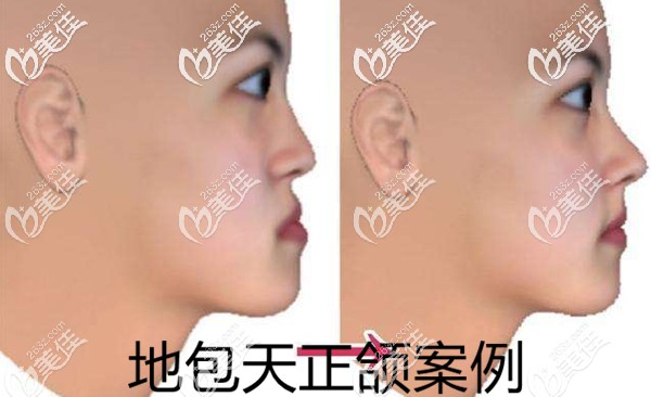 地包天正頜前后效果 地包天正頜前后效果