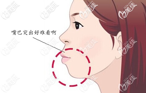 女朋友的輕微齙牙好難看 女朋友的輕微齙牙好難看