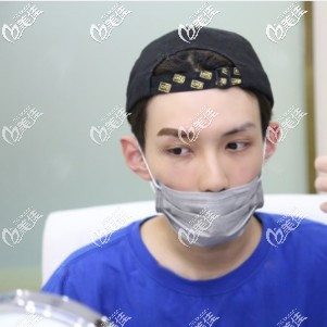 醫(yī)生設(shè)計的眉毛種植方案 醫(yī)生設(shè)計的眉毛種植方案