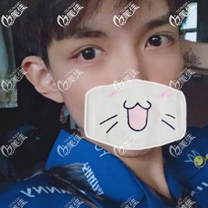 植眉術(shù)后7天效果圖 植眉術(shù)后7天效果圖