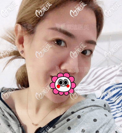 找北京做眼袋厲害的張金娥醫(yī)生做不開刀祛眼袋半個月效果