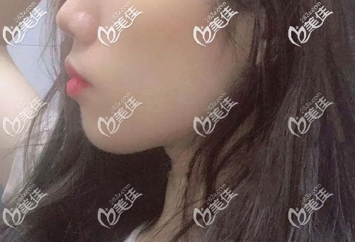 女朋友的輕微齙牙好難看,沒想到做完正畸后對她骨性嘴凸的改善效果這么贊！