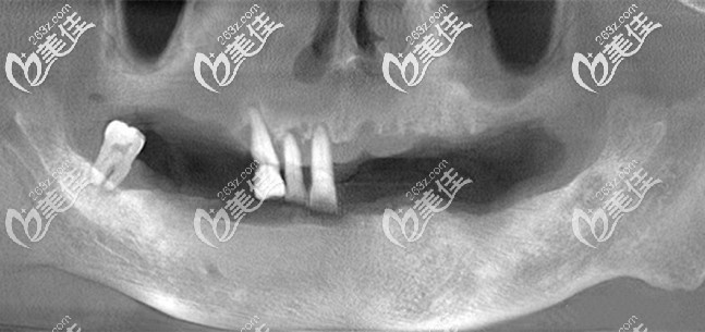 缺失牙前拍得CT片 缺失牙前拍得CT片