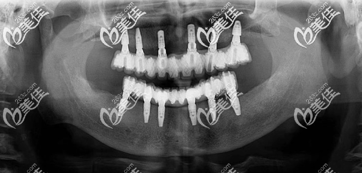 60歲老人牙齒拔了10年沒裝假牙，為了心愿在沈陽花14萬做了韓國登騰全口種植牙