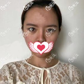 做雙眼皮術(shù)前照 做雙眼皮術(shù)前照