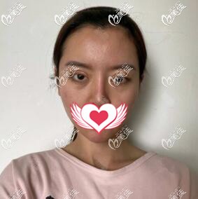 割雙眼皮術(shù)后5天恢復(fù)圖 割雙眼皮術(shù)后5天恢復(fù)圖