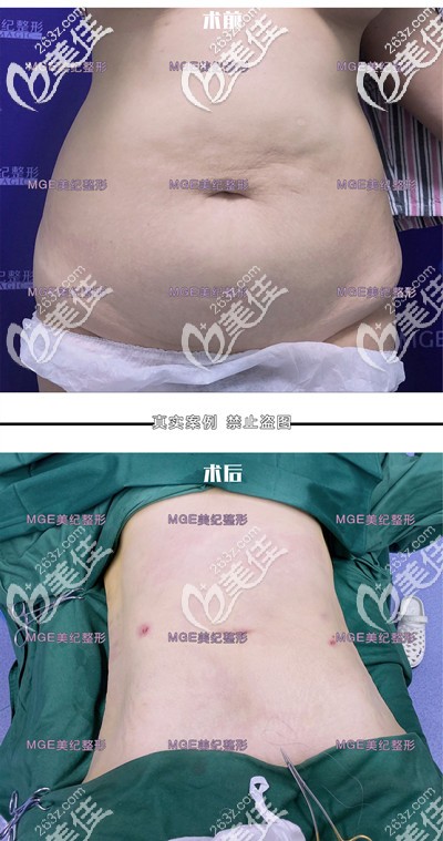 做腰腹部吸脂前后對(duì)比照