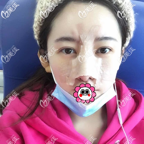 假體隆鼻術(shù)后恢復(fù)4天 假體隆鼻術(shù)后恢復(fù)4天