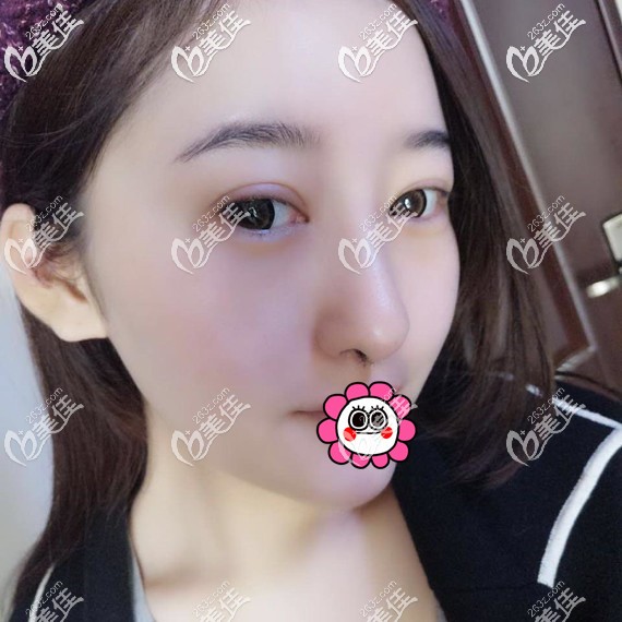 假體隆鼻7天到醫(yī)院拆線 假體隆鼻7天到醫(yī)院拆線