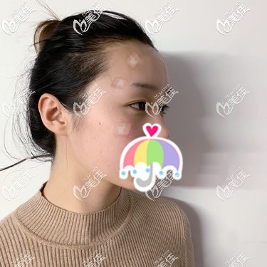 全臉自體脂肪填充術(shù)后即刻飽滿