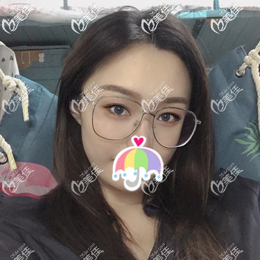 自體脂肪面部填充術(shù)后46天腫脹漸消