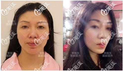 pst面部提升真實真人案例