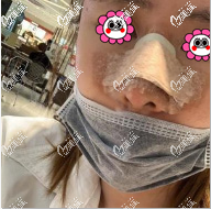 在泰國TARA CLINIC整形醫(yī)院做鼻修復第4天