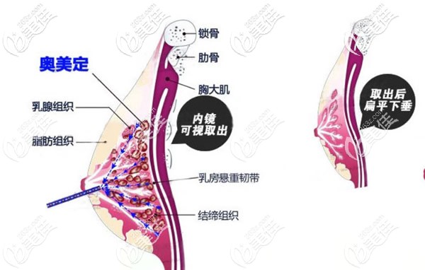 取出奧美定后乳房形狀圖