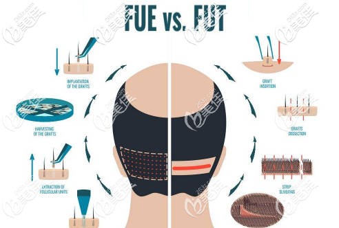 FUE和FUT植發(fā)技術(shù)過程演示