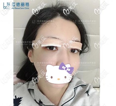 大連雙眼皮修復(fù)術(shù)后當天照