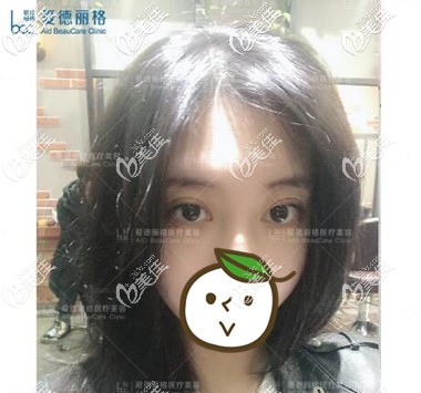 在大連修復(fù)雙眼皮術(shù)后第5天照