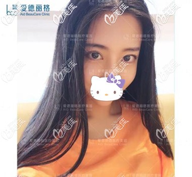 雙眼皮失敗修復(fù)術(shù)后半個月效果照