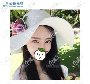 埋線雙眼皮失敗修復(fù)術(shù)后1個月照