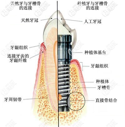 種植牙的結(jié)構(gòu)圖