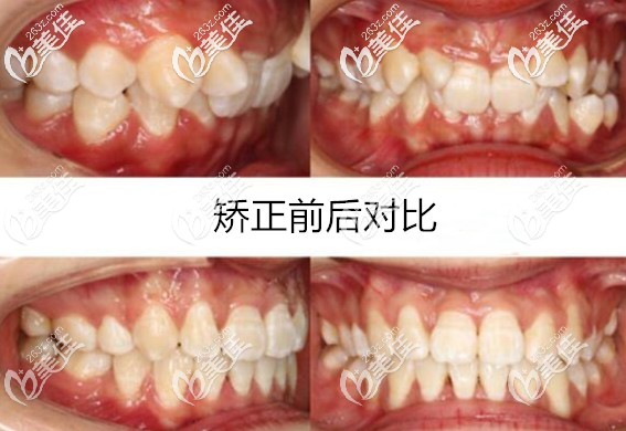 這是我一個(gè)26歲老阿姨在義烏傅氏口腔做深覆蓋牙齒矯正的案例哦，有沒有和我一樣矯正后像墊下巴的？