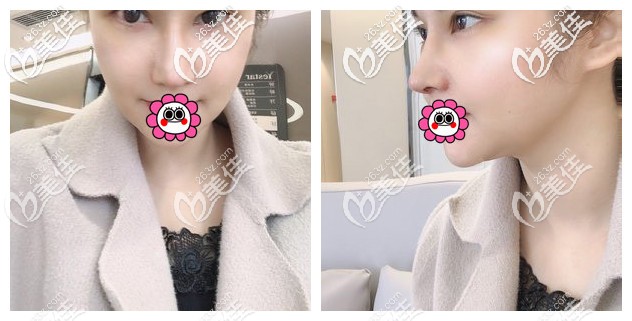 肋軟骨隆鼻恢復(fù)7天拆線 肋軟骨隆鼻恢復(fù)7天拆線