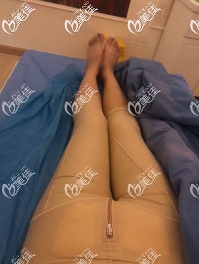 在煙臺(tái)鵬愛(ài)做吸脂手術(shù)后的當(dāng)天的樣子 在煙臺(tái)鵬愛(ài)做吸脂手術(shù)后的當(dāng)天的樣子