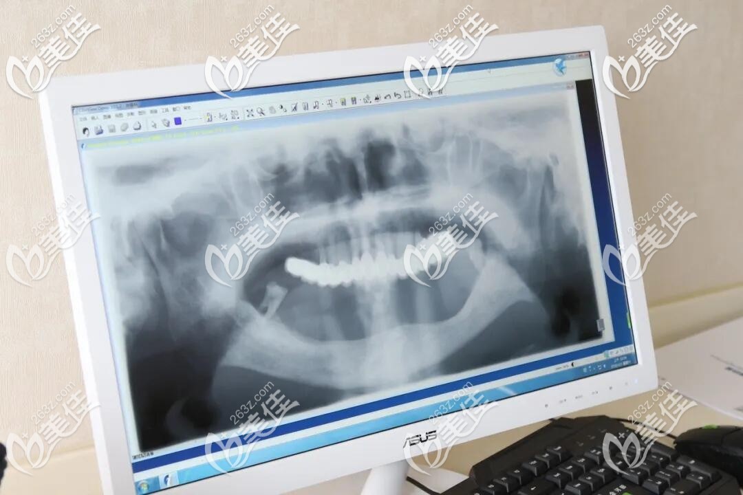 種植牙前拍片圖示 種植牙前拍片圖示