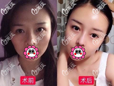 自體脂肪面部填充效果對(duì)比圖