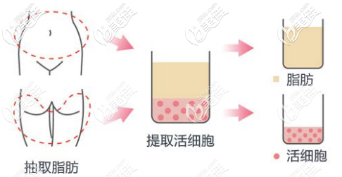 自體脂肪面部填充示意圖