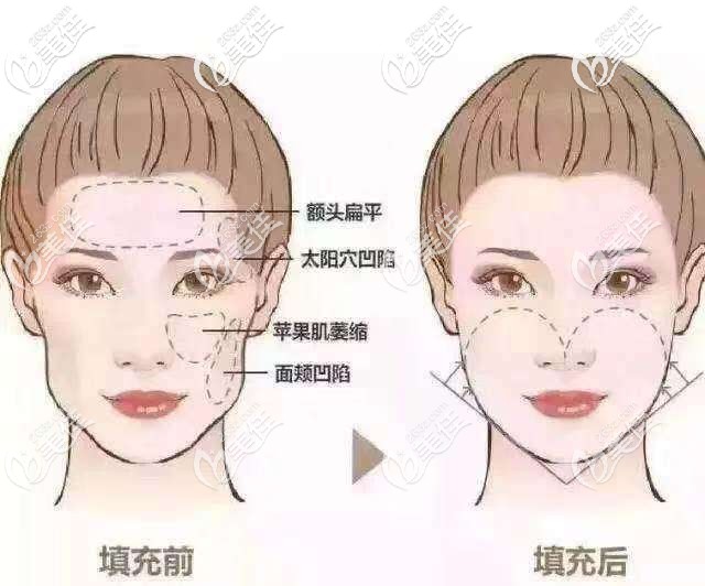 面部容易凹陷部位示意圖