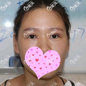 切開(kāi)雙眼皮+開(kāi)眼角術(shù)后7天拆線 切開(kāi)雙眼皮+開(kāi)眼角術(shù)后7天拆線