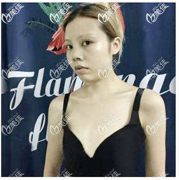 找許揚(yáng)濱做隆胸術(shù)前照片 找許揚(yáng)濱做隆胸術(shù)前照片