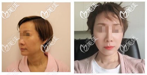 pst面部提升案例