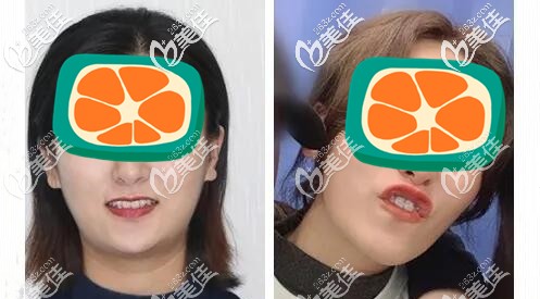 真后悔戴隱形牙套做深覆合矯正,其實鋼絲牙套做深覆合矯正前后臉型變化還賊大,也改善了嘴凸