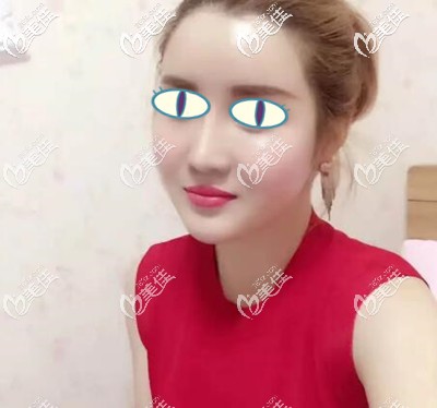 得知大連自體脂肪填充哪家醫(yī)院做的好后我找關(guān)世超做了面部填充手術(shù)，給大家看下2個月的恢復(fù)效果！