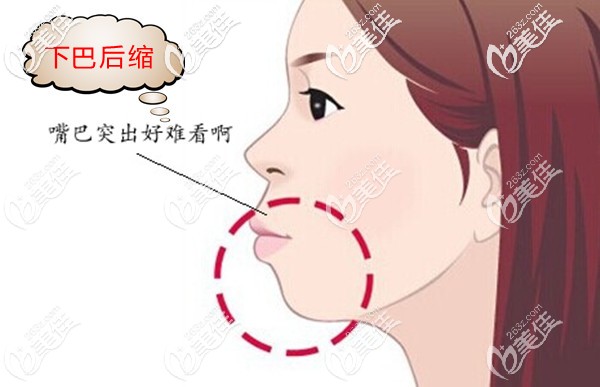 下巴后縮+凸嘴怎么改善 下巴后縮+凸嘴怎么改善