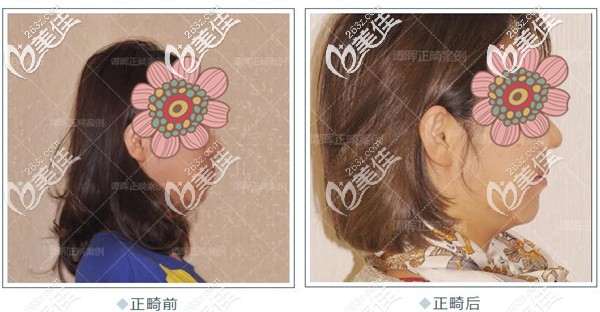 下巴后縮在北京維樂(lè)口腔做矯正的效果 下巴后縮在北京維樂(lè)口腔做矯正的效果