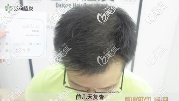 ?很多人植發(fā)兩三年基本脫落了是什么鬼?我植發(fā)4年后二次補(bǔ)種因?yàn)轭^旋頭發(fā)少要加密