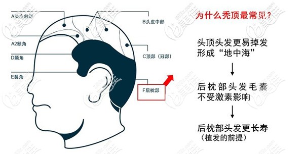 植發(fā)移植的后枕部毛囊所以能夠長久保持 植發(fā)移植的后枕部毛囊所以能夠長久保持